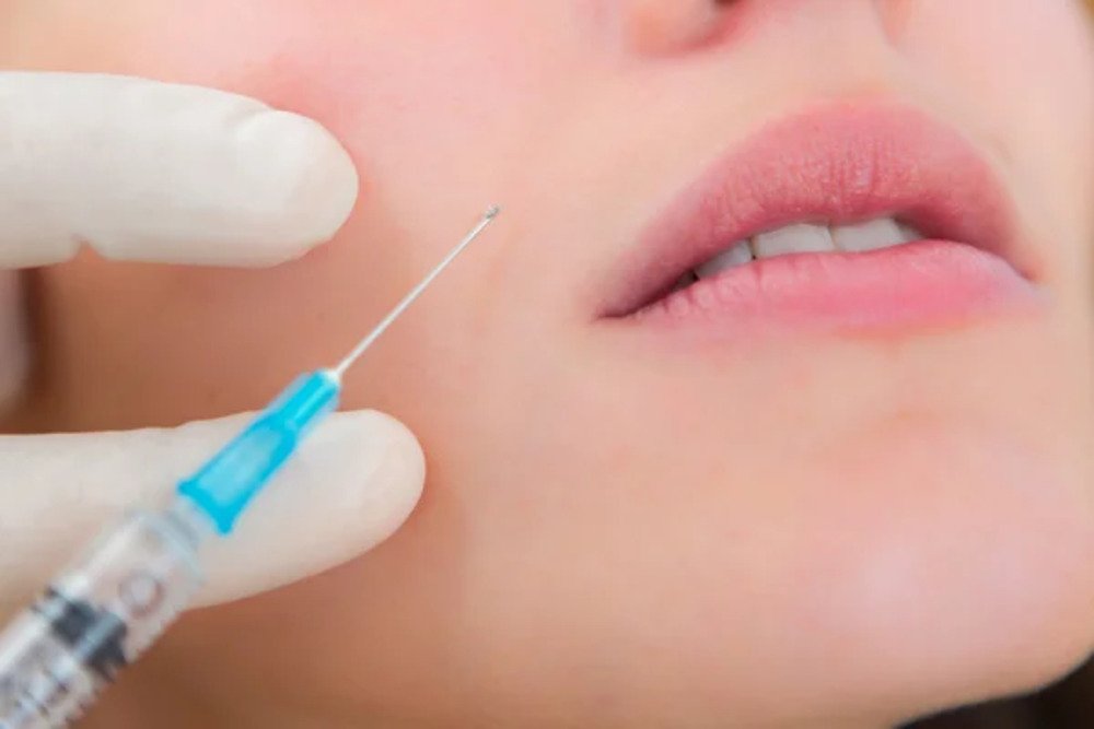 Dermal Fillers Small 1