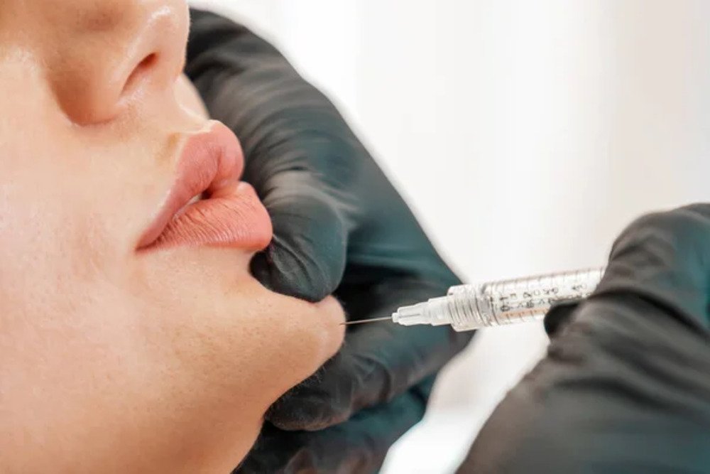 Dermal Fillers Small 2