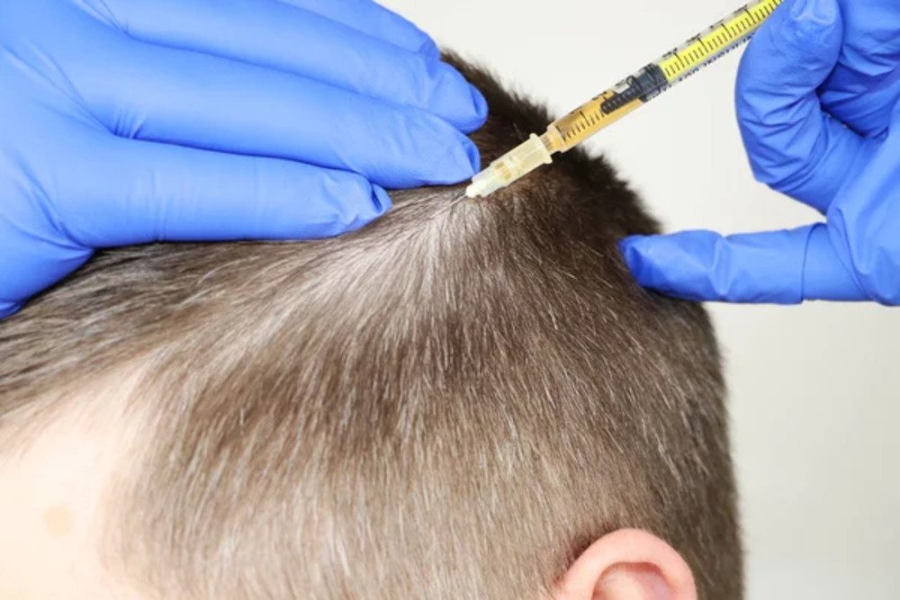 PRP Hair Restoration Small.1 jpg