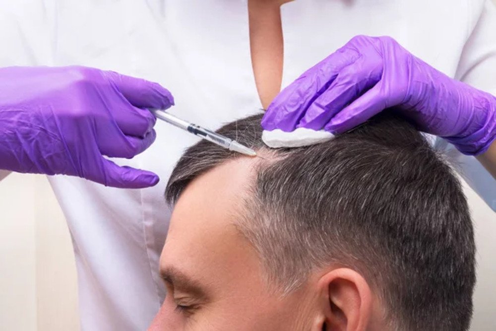 PRP Hair Restoration Small.2 jpg
