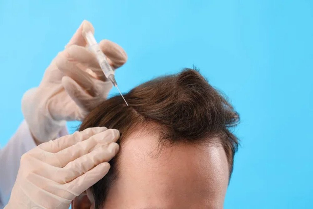 PRP Hair Restoration Small.3jpg